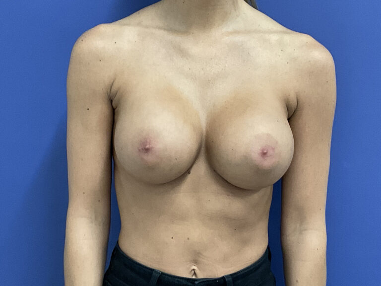 After Image: Patient # 5302 - front
