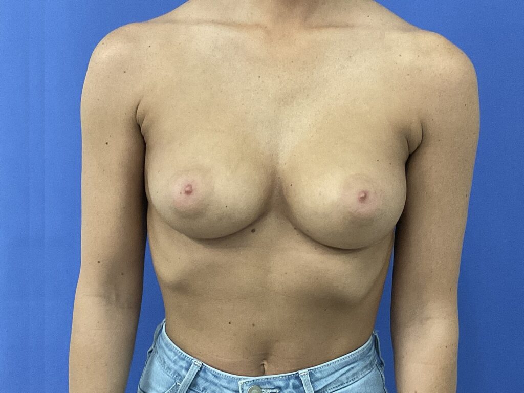 Before Image: Patient # 5302 - front