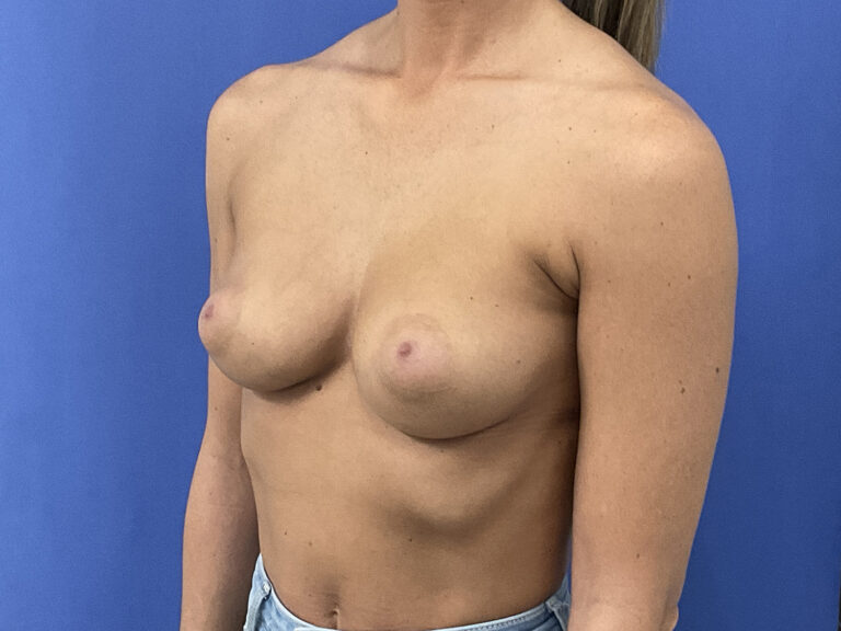 Before Image: Patient # 5302 - left-front-oblique