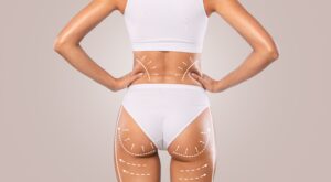 A back view of a woman in white underwear showing the results of BodyTite