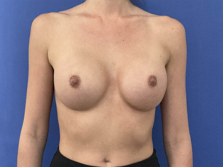 After Image: Patient # 5491 - front