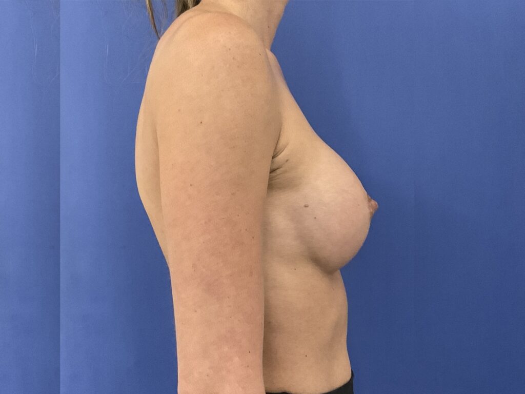 After Image: Patient # 5491 - right-side