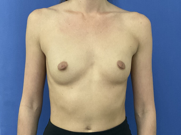 Before Image: Patient # 5491 - front