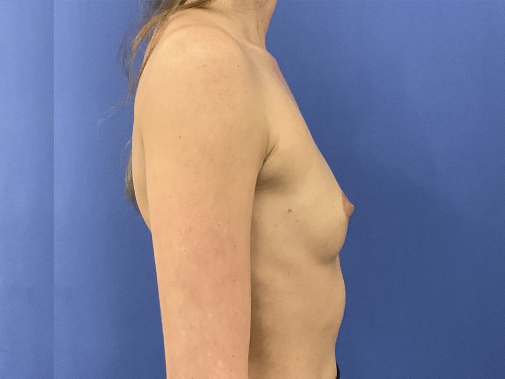 Before Image: Patient # 5491 - right-side