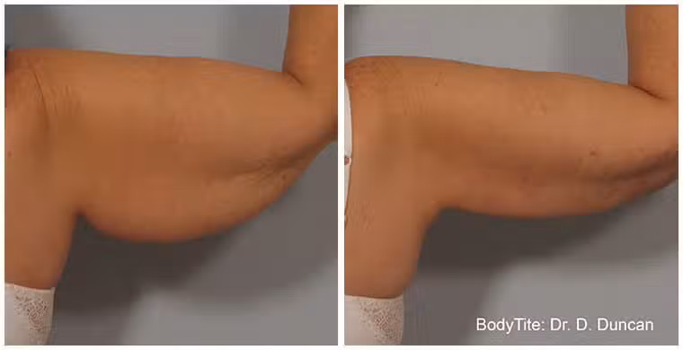 BodyTite-before-after-1.jpg BodyTite before after 1.jpg