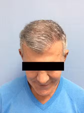 Hair Transplant in La Jolla & Carlsbad, CA 4 neografta1 2.jpg