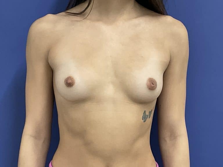 Before Image: Patient # 13540 - front
