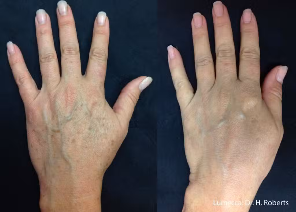 IPL Laser Treatment in La Jolla & Carlsbad, CA 6 unnamed 1024x734 1.jpg