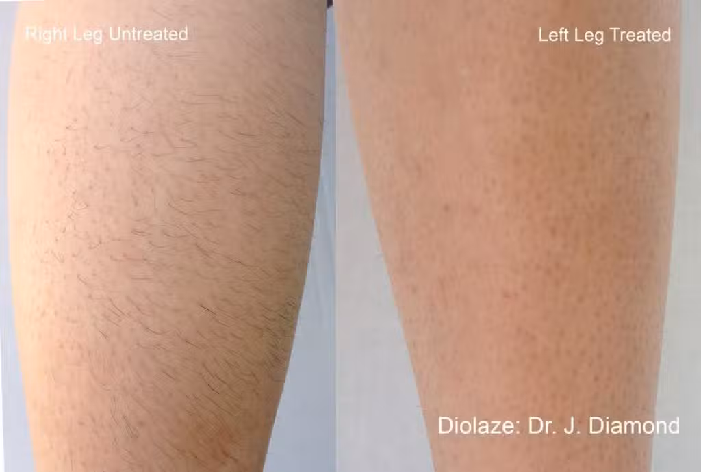 Laser Hair Removal in La Jolla & Carlsbad, CA 2 unnamed 2 1024x690 1.jpg