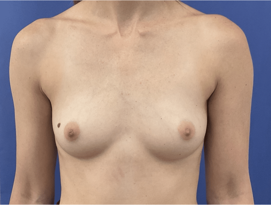 Before Image: Patient # 88195 - front