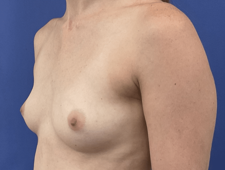 Before Image: Patient # 88195 - left-front-oblique