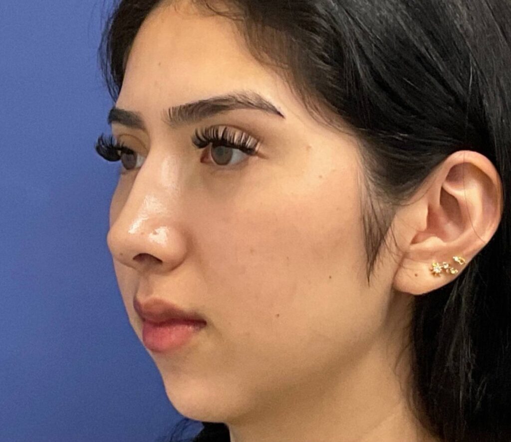 After Image: Rhinoplasty/Septoplasty - left-front-oblique