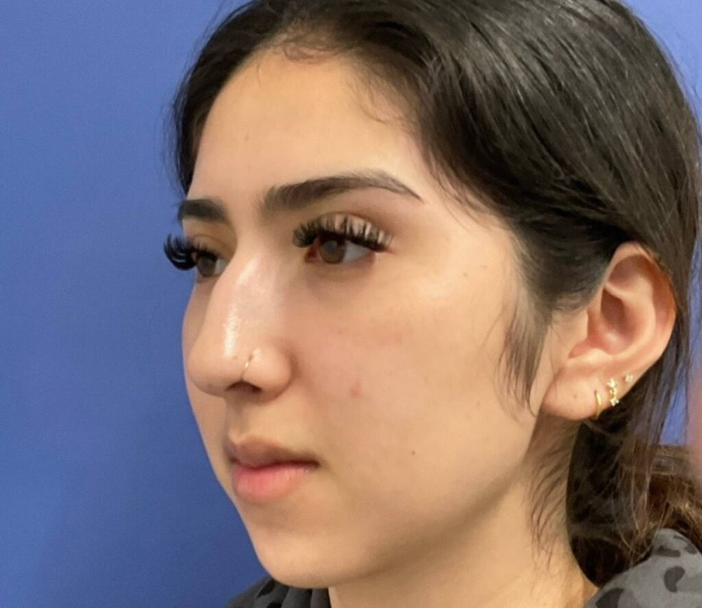 Before Image: Rhinoplasty/Septoplasty - left-front-oblique