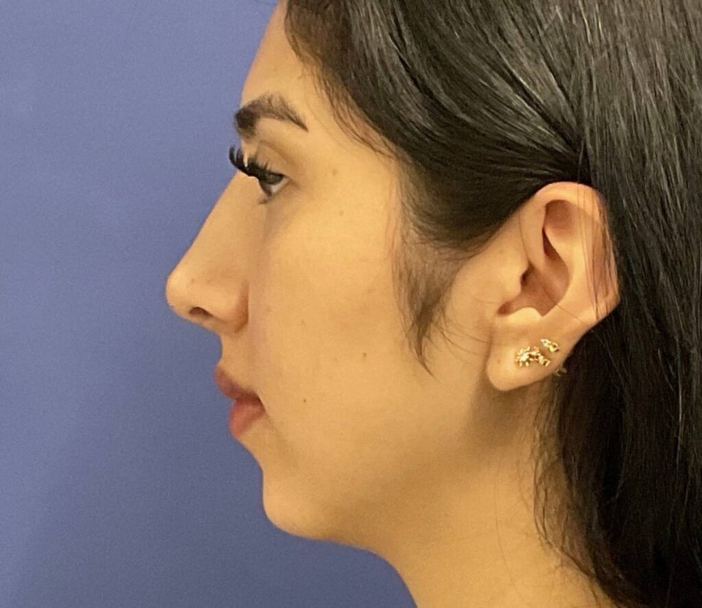 After Image: Rhinoplasty/Septoplasty - left-side
