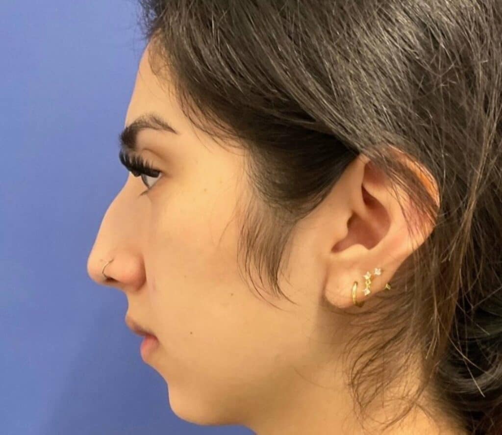 Before Image: Rhinoplasty/Septoplasty - left-side